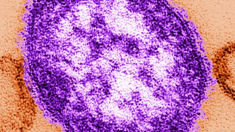 Measles: Adult woman dies amid growing Pennsylvania outbreak